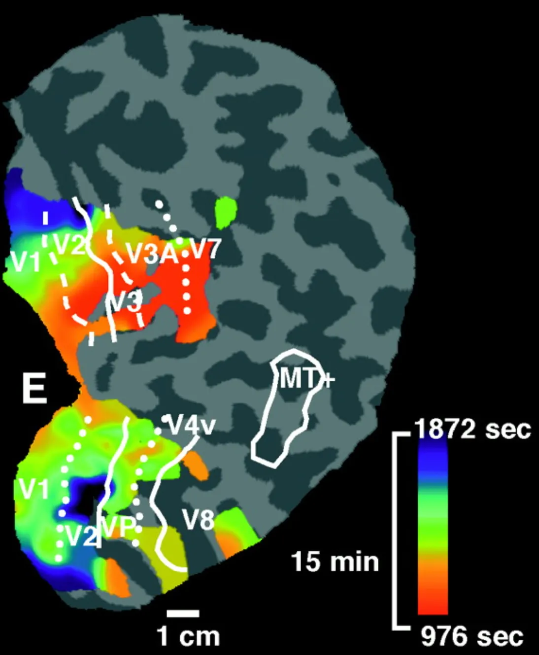 Kernspintomographie des Verlaufes einer Erregungswelle bei Migräne in der Großhirnrinde (N. Hadjikhani et al. PNAS 2001)
